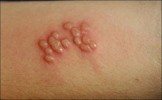 Illustration for article titled Obat Penyakit Herpes Genital